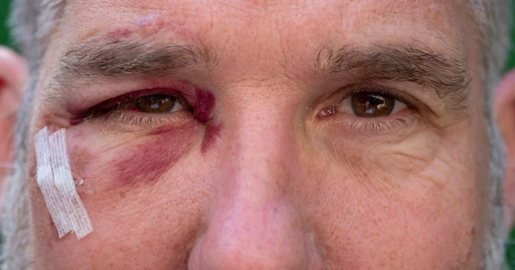 hematoma-ocular