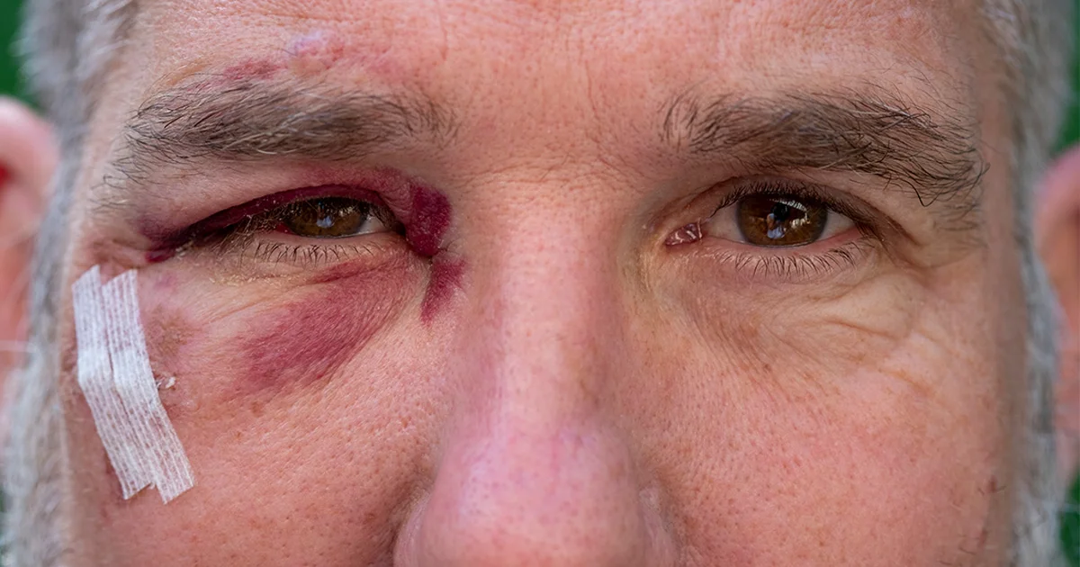 hematoma-ocular